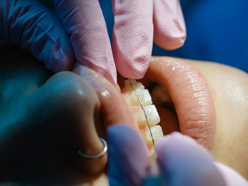 Braces For Upper Teeth